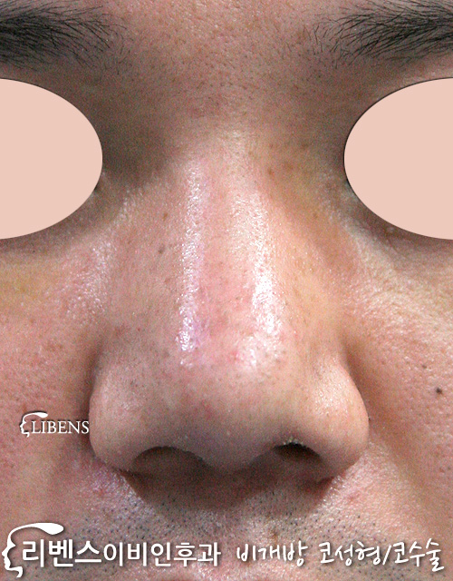 비대칭 콧구멍 화살코 교정 수술 매부리코 메부리코 코끝 비중격만곡증 성형 s112